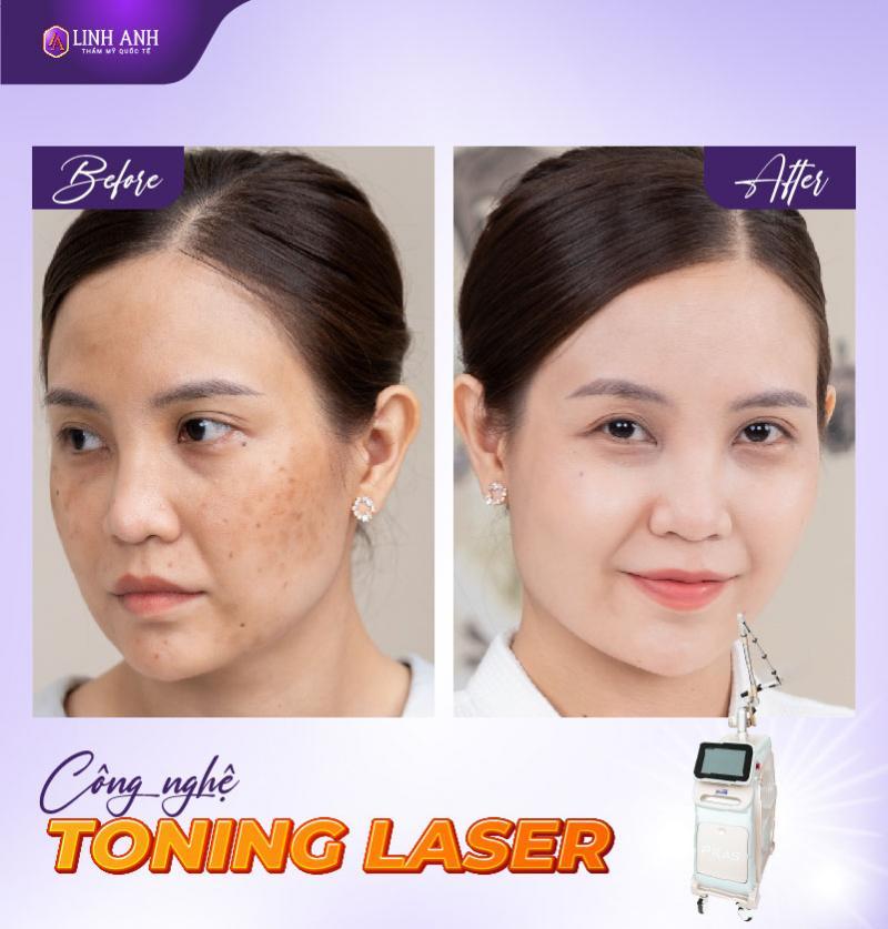 Top 9 Địa Chỉ Trị Nám, Tàn Nhang Uy Tín Tại Đà Nẵng